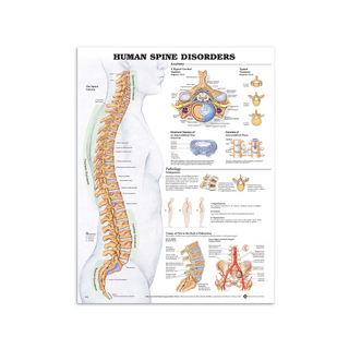 Cartaz sobre doença da coluna vertebral em inglês