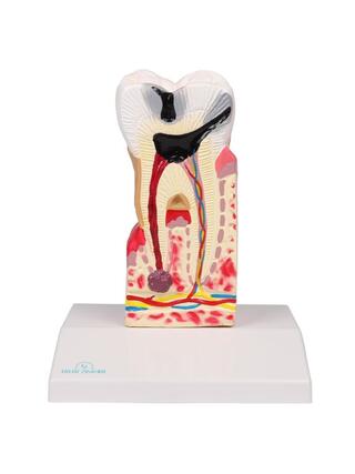 Modelo de cárie dentária, 10 vezes o tamanho real