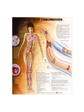Trombose venosa profunda (TVP) - pôster