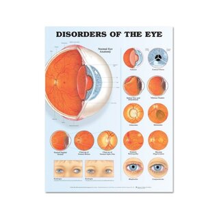 Cartaz laminado sobre doenças oculares (distúrbios oculares)
