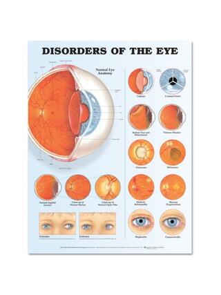 Cartaz laminado sobre doenças oculares (distúrbios oculares)