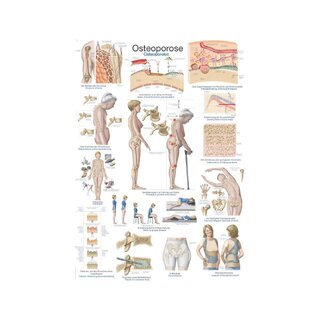 Pôster sobre Osteoporose, Pôster Anatômico 50x70cm