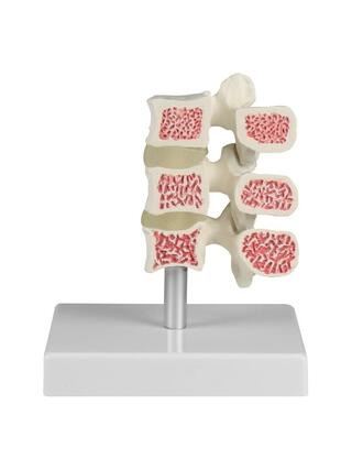 Modelo de vértebra com osteoporose, 3 vértebras