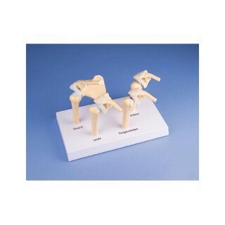 Modelo de osteoartrite (OA) em estágio 4 do ombro